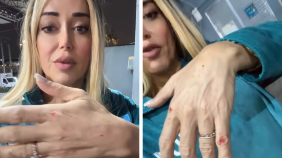 mulher-abacaxi-sofre-tentativa-de-assalto-em-sp-e-mostra-escoriacoes-na-mao