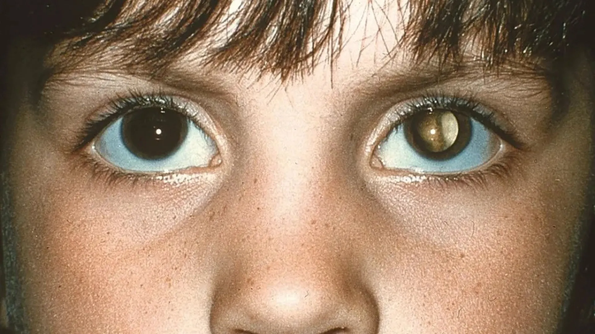 cuidados-na-infancia:-‘olhos-brancos’-apos-tirar-foto-pode-indicar-tumor