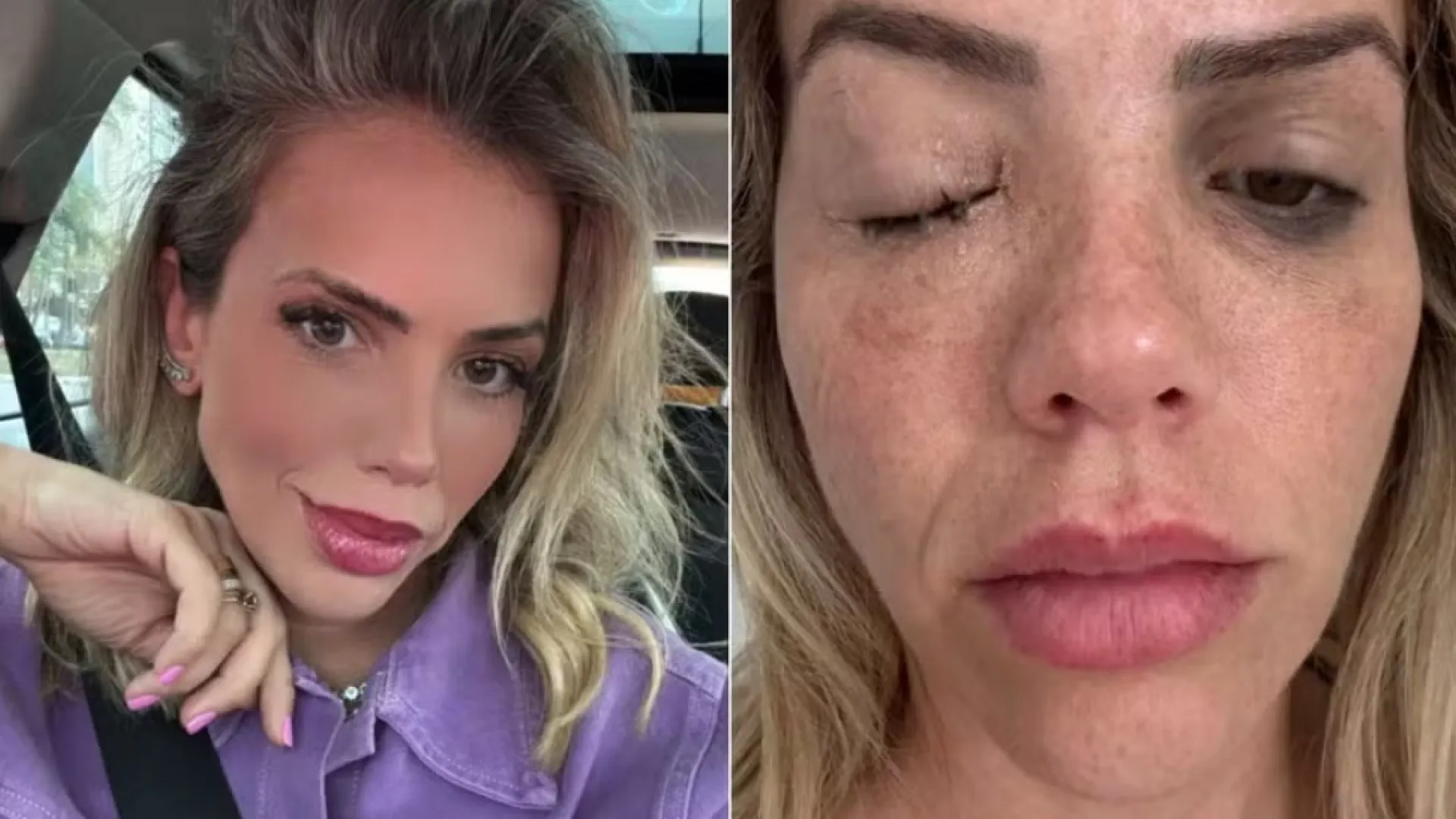 apresentadora-e-infectada-por-bacteria-com-poder-de-cegar