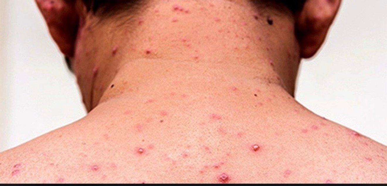 sarampo-de-volta-as-americas