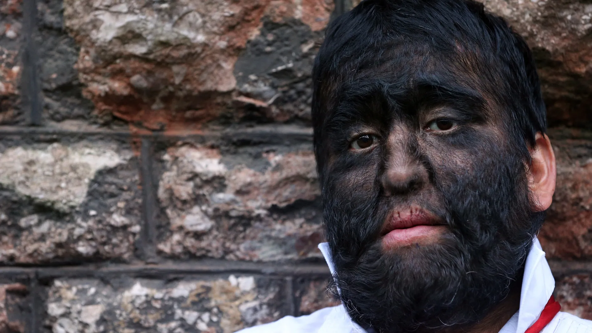 doencas-raras-que-parecem-inventadas,-mas-sao-reais