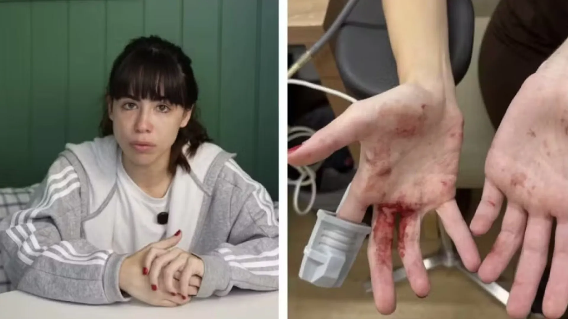 atriz-nina-baiocchi-mostra-ferimentos-apos-ser-assaltada-em-sp