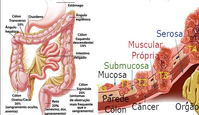 Câncer colorretal avança entre jovens e já atinge 1 em cada 5 pacientes antes dos 55 anos