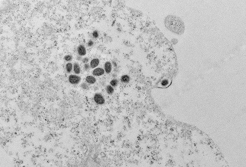brasil-registra-140-casos-confirmados-de-mpox-em-2026,-aponta-ministerio-da-saude