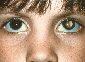 cuidados-na-infancia:-‘olhos-brancos’-apos-tirar-foto-pode-indicar-tumor
