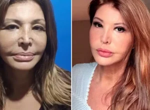 lembra-dela?-musa-dos-anos-90-recorre-a-harmonizacao-facial