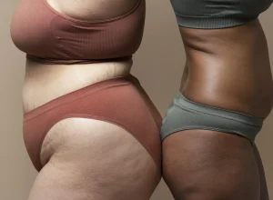 lipedema:-uma-doenca-pouco-conhecida-e-com-impacto-significativo