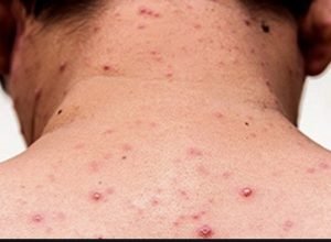 sarampo-de-volta-as-americas