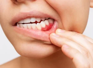 cancer-de-boca-esta-entre-os-mais-incidentes-no-brasil