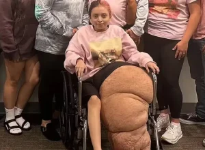 garota-de-14-anos-passa-por-cirurgia-de-17h-para-remover-a-perna-de-79kg