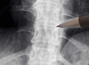 anvisa-libera-estudo-com-medicamento-para-lesoes-na-medula-espinhal