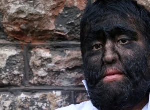 doencas-raras-que-parecem-inventadas,-mas-sao-reais