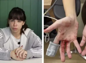 atriz-nina-baiocchi-mostra-ferimentos-apos-ser-assaltada-em-sp