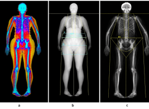 estudo-aponta-relacao-entre-gordura-abdominal-e-maior-risco-de-perda-urinaria-em-mulheres